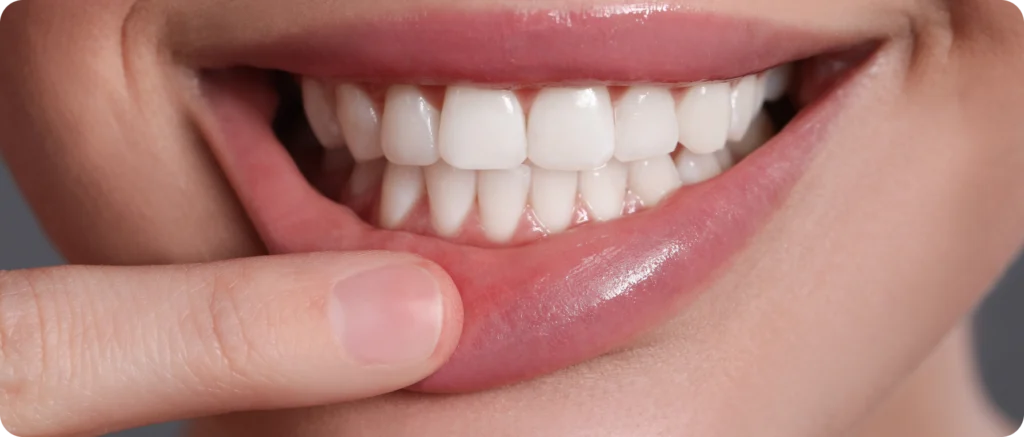 blanchiment dentaire parodontologie hygiene Chirurgie mucco-gingivale Dr Benjamin Girod