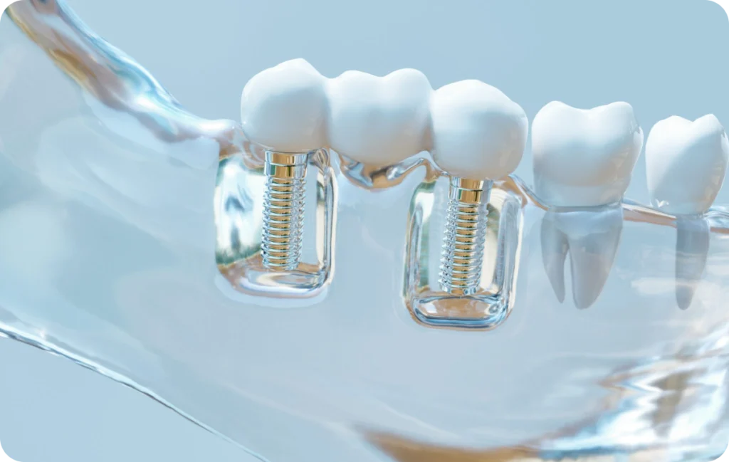 bridge dr benjamin girod implant dentaire Prothèses fixes Dr Benjamin Girod