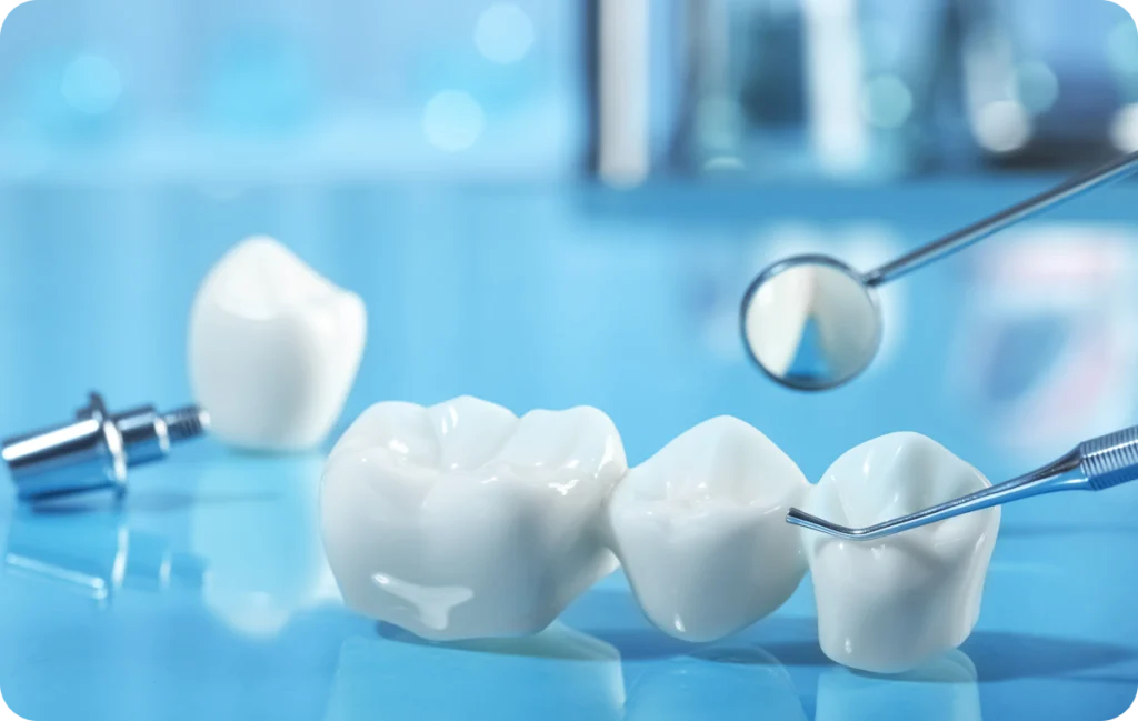 bridge implant lagnieu Prothèses fixes Dr Benjamin Girod