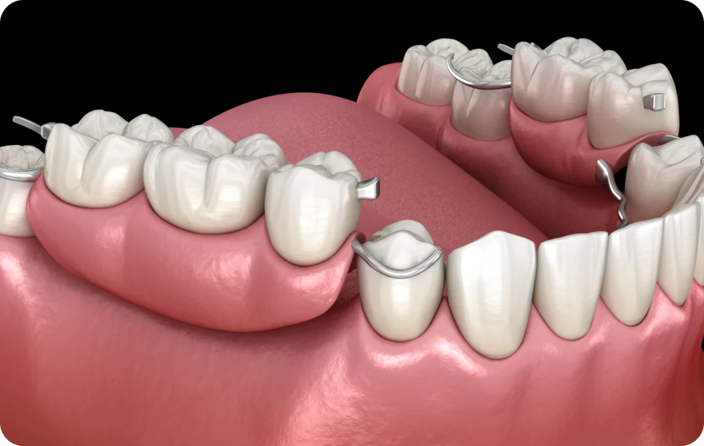 bridge lagnieu Réhabilitation dentaire Dr Benjamin Girod