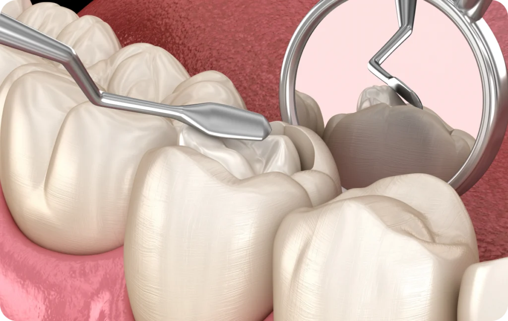 composite dentiste lagnieu Dentisterie adhésive Dr Benjamin Girod