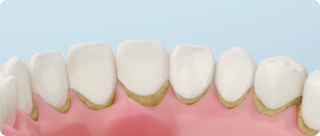 detartage dr girod lagnieu L'importance du détartrage Dr Benjamin Girod