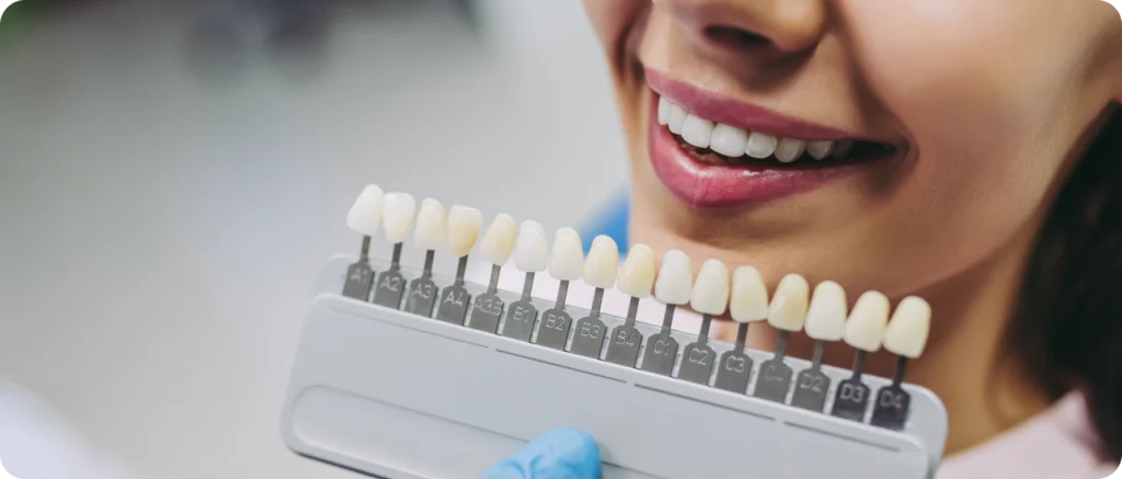 facettes dentaires chirurgie mucco Facettes dentaires Dr Benjamin Girod