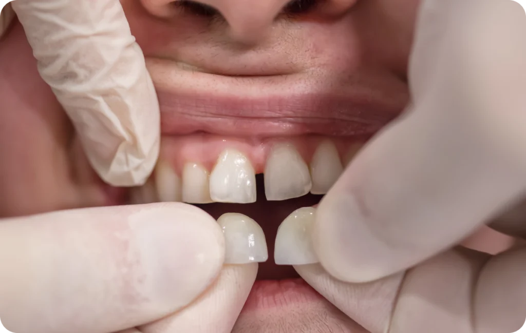 facettes dentaires dentisterie hygiene Facettes dentaires Dr Benjamin Girod