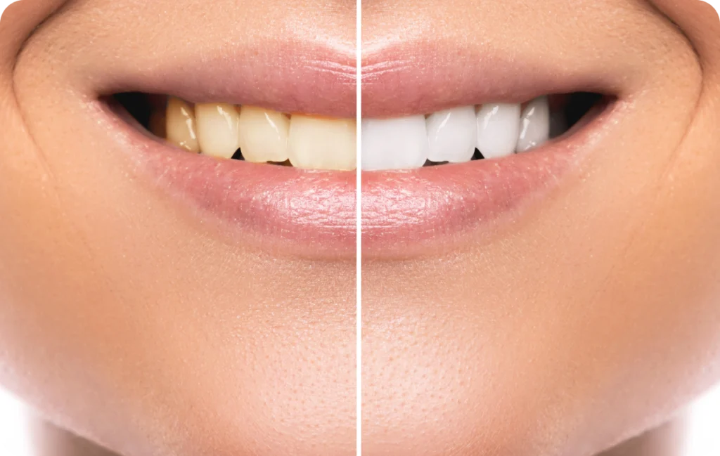 facettes dentaires hygiene dentaire Blanchiment dentaire Dr Benjamin Girod