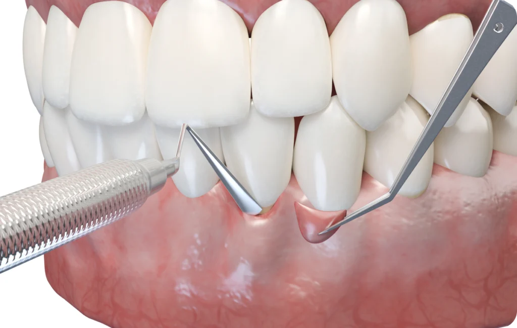 greffe gingivale cabinet dentaire lagnieu Chirurgie mucco-gingivale Dr Benjamin Girod