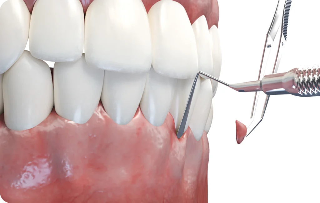 greffe gingivale dentiste lagnieu Chirurgie mucco-gingivale Dr Benjamin Girod