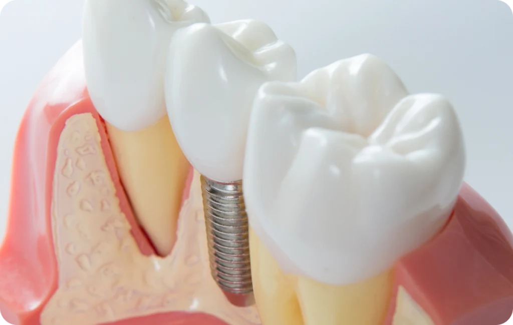 implant dentaire chirurgie mucco gingival lagnieu Dent manquante Dr Benjamin Girod