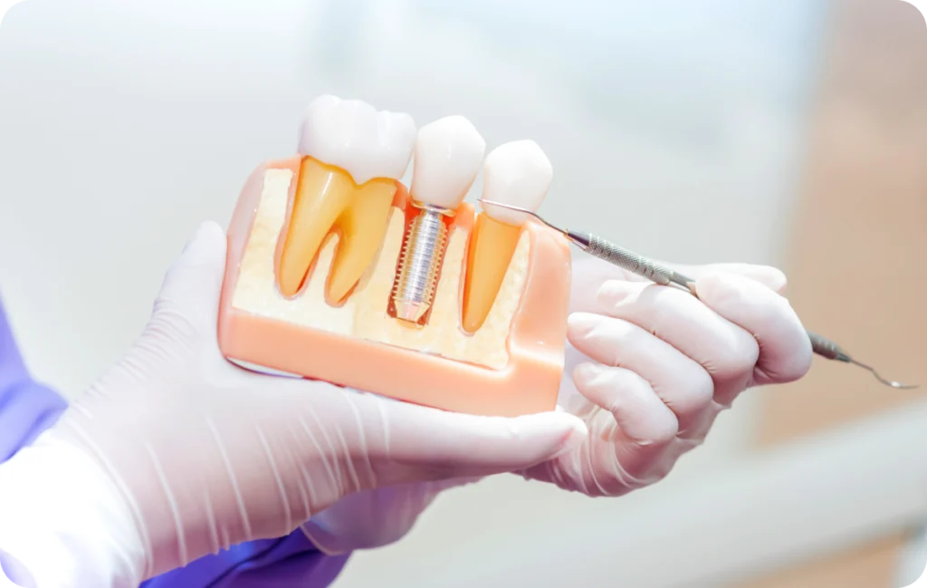 dentiste lagnieu implant dentaire Pose d'implant Dr Benjamin Girod