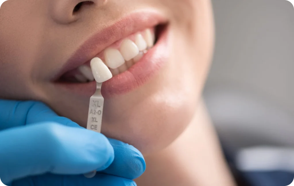 lagnieu chirurgie mucco gingival facettes Facettes dentaires Dr Benjamin Girod