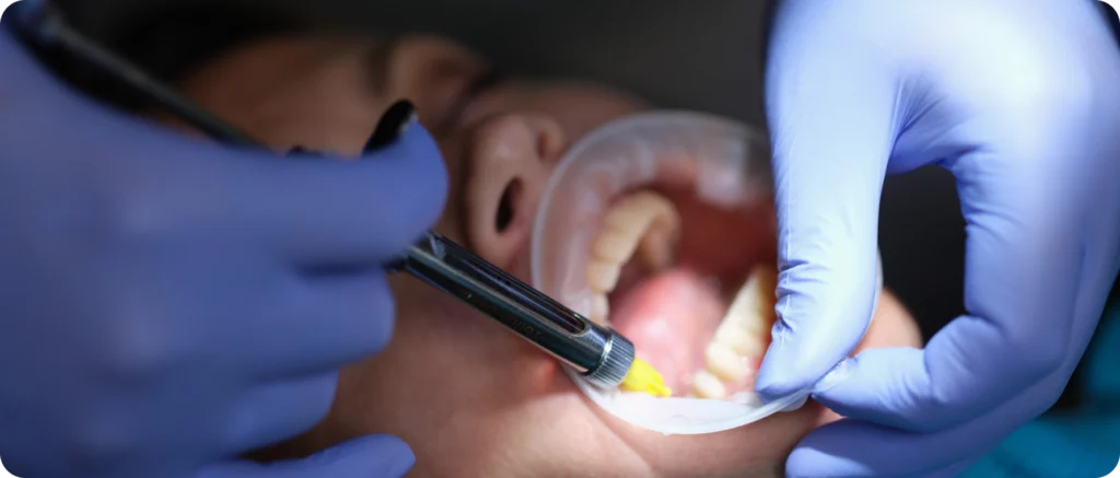 lagnieu dentisterie adhesive rehabilitation Dentisterie adhésive Dr Benjamin Girod