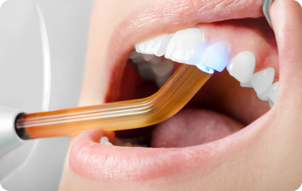 lagnieu implant dentaire rehabilitation Dentisterie adhésive Dr Benjamin Girod