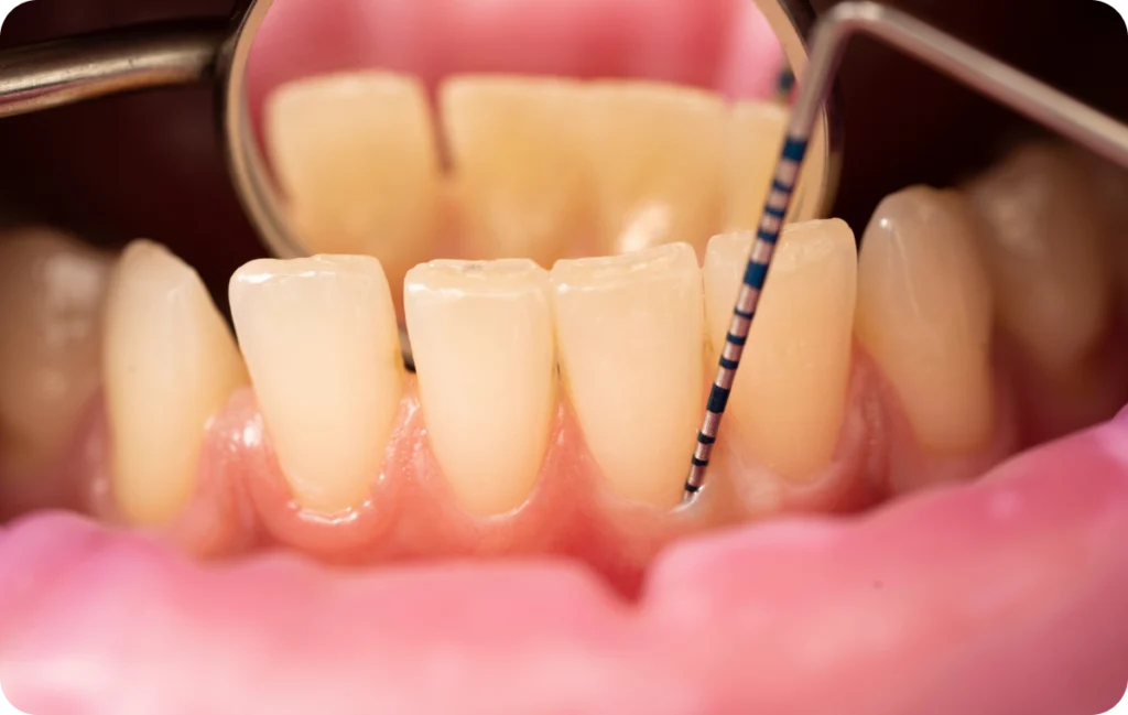 parodontologie maladies hygiene dentaire Comment prendre soin de vos gencives ? Dr Benjamin Girod