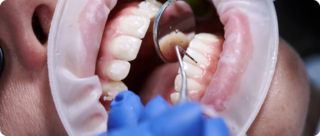 parodontologie maladies lagnieu Maladies parodontales Dr Benjamin Girod