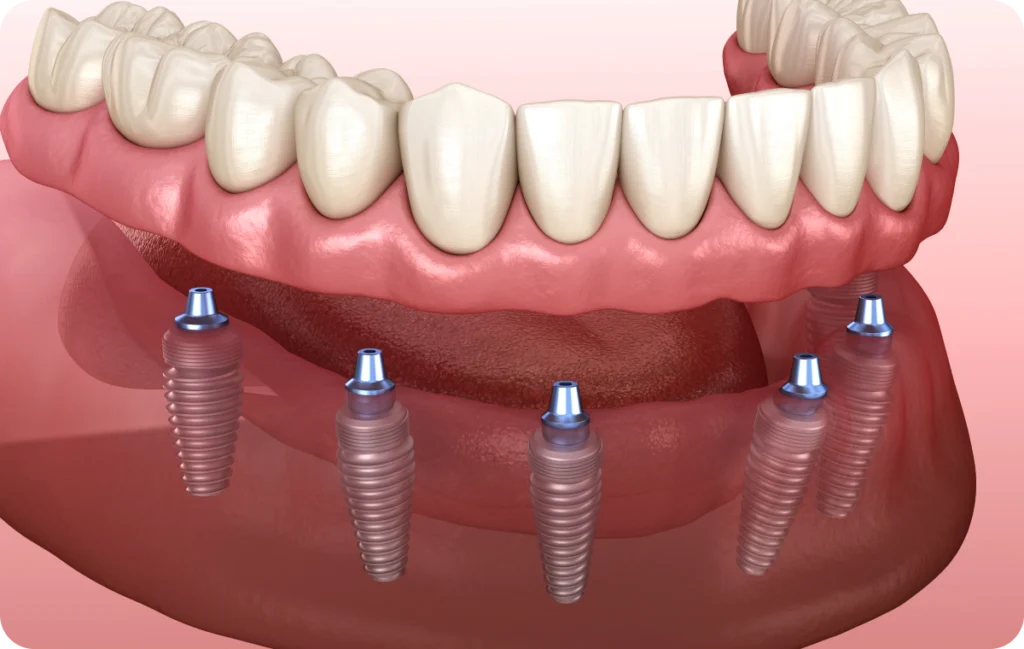 protheses amovibles rehabilitation dentaire lagnieu Prothèses amovibles Dr Benjamin Girod