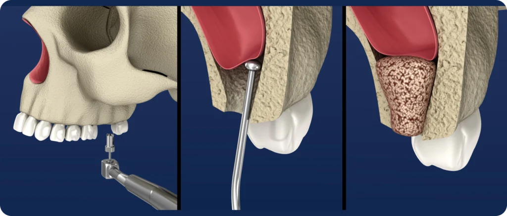 sinus lift lagnieu Chirurgie pré-implantaire Dr Benjamin Girod